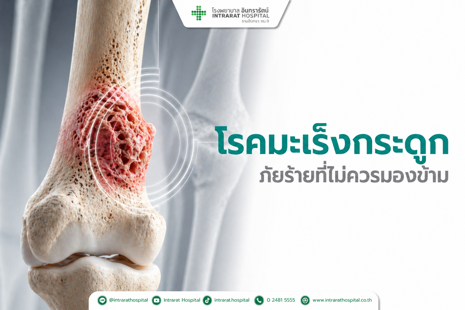 โรคมะเร็งกระดูก(Bone Cancer)