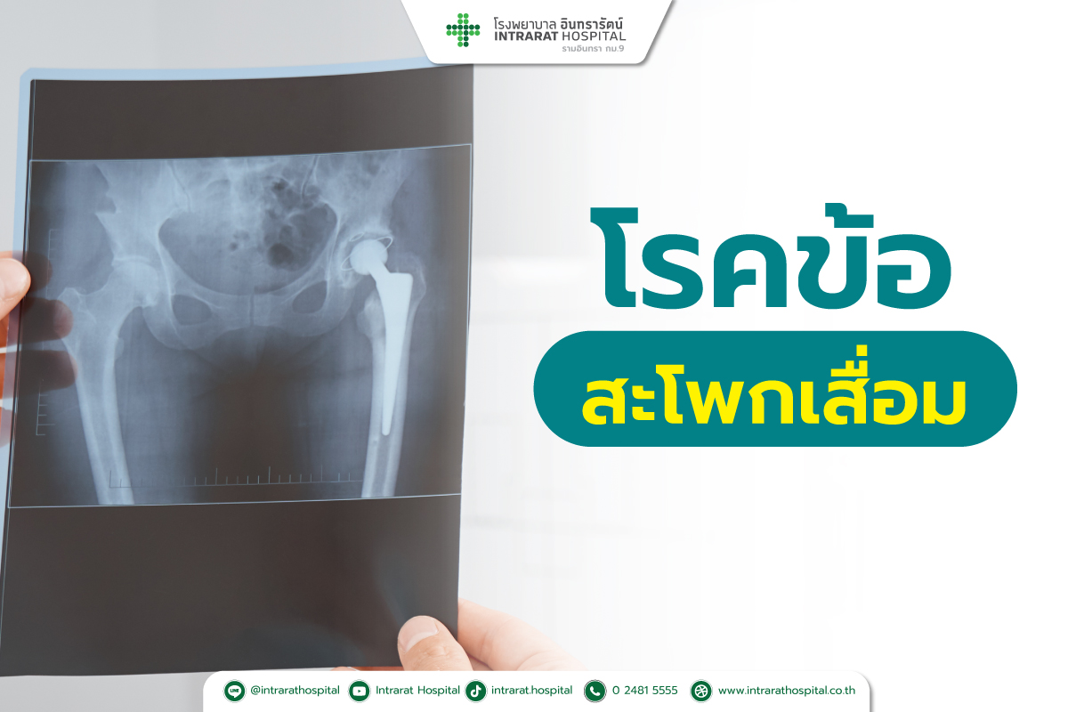 สัญญาณเตือน ข้อสะโพกเสื่อม อันตรายอย่าปล่อยไว้