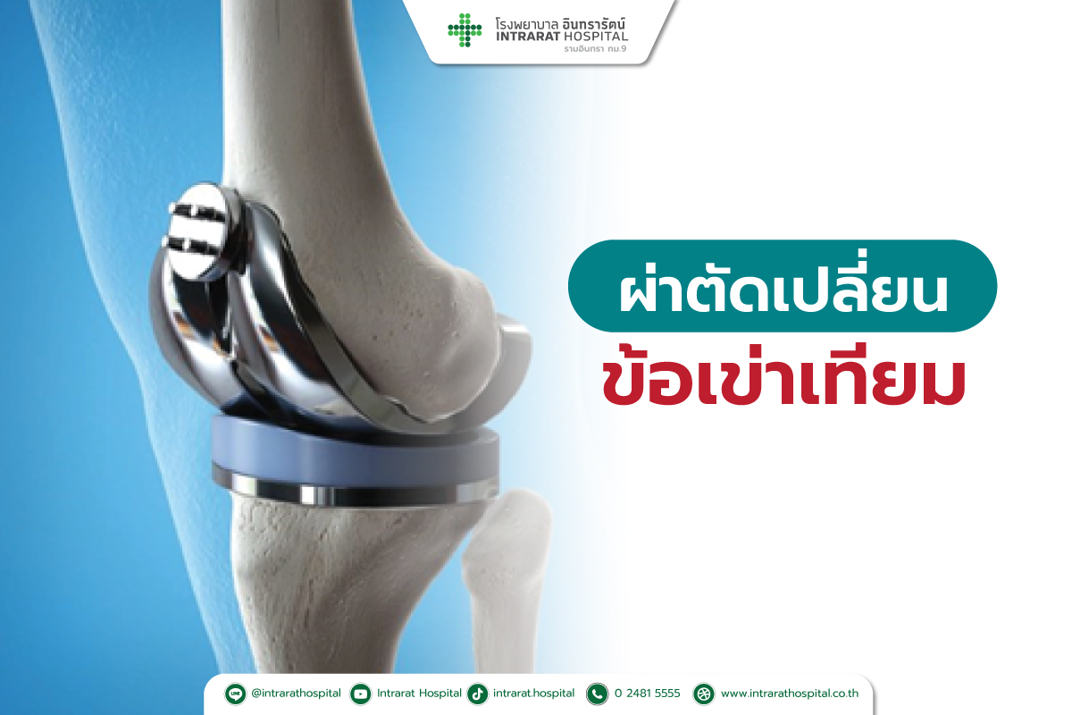 การผ่าตัดเปลี่ยนข้อเข่าเทียม