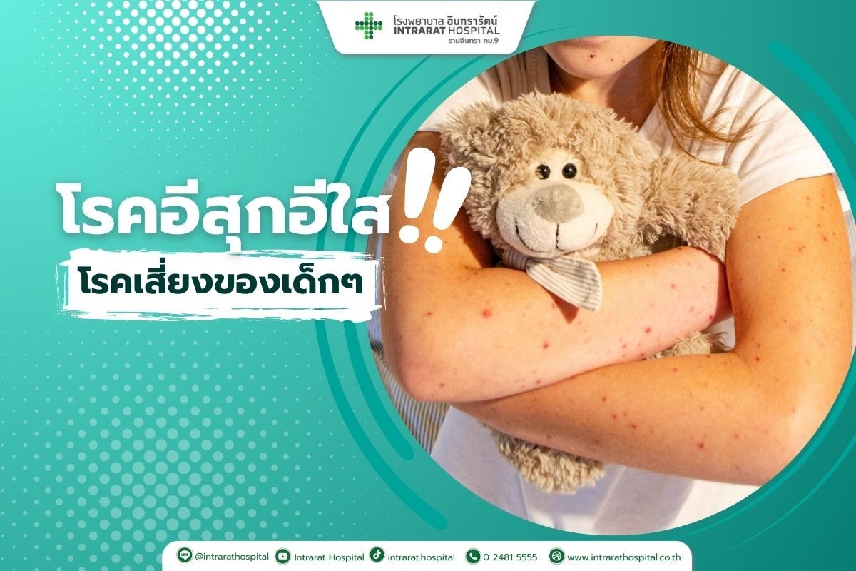 โรคอีสุกอีใส (Chickenpox หรือ Varicella)