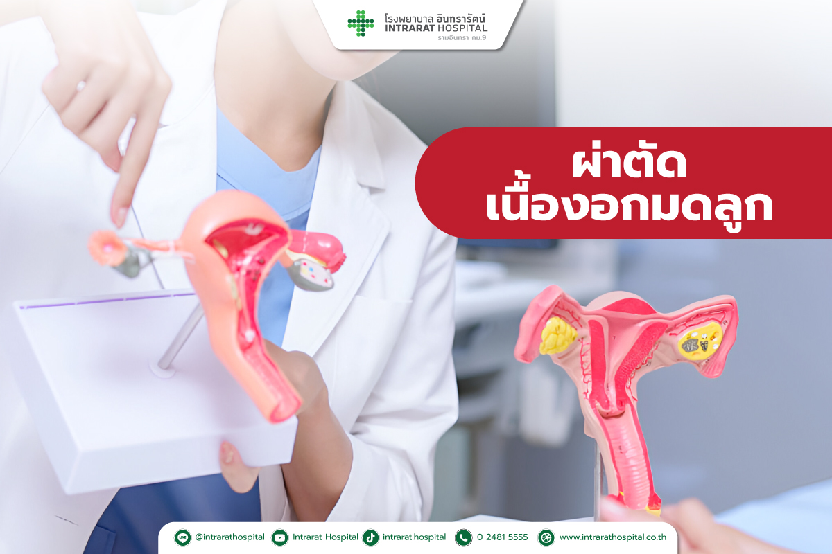 การผ่าตัดเนื้องอกมดลูก (Myomectomy) 