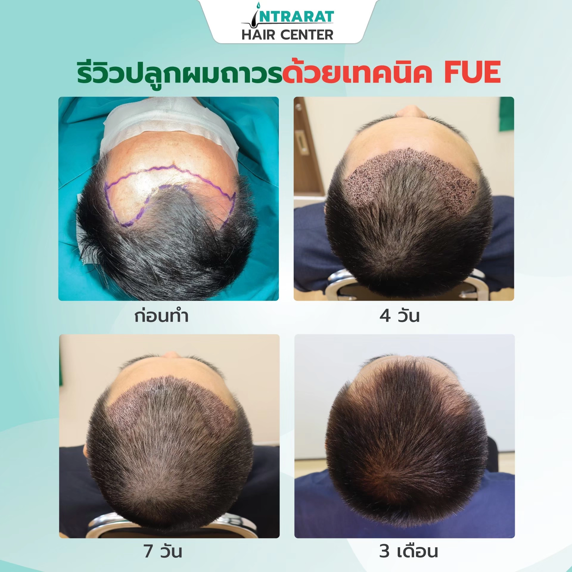 ศัลยกรรมปลูกผมถาวรด้วยเทคนิค FUE 