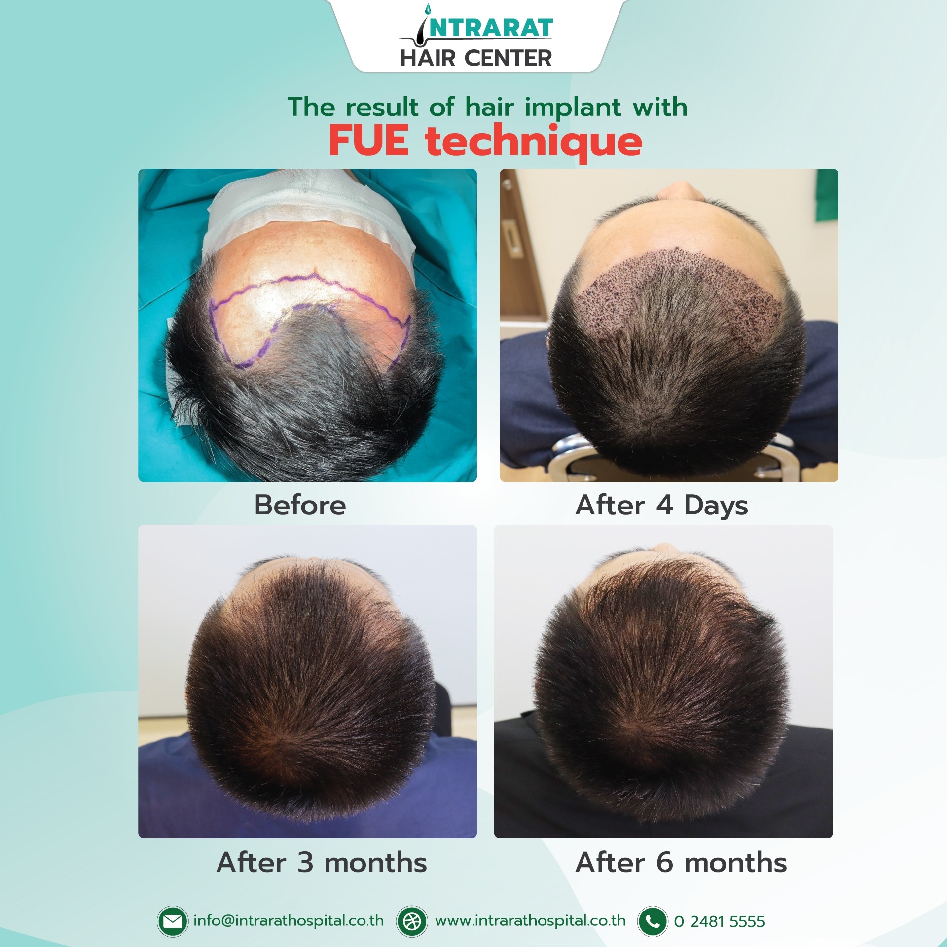 ဘေးကင်းစိတ်ချရသော FUE FIRST နည်းပညာအသုံးပြု၍ ဆံပင်စိုက်ခြင်း