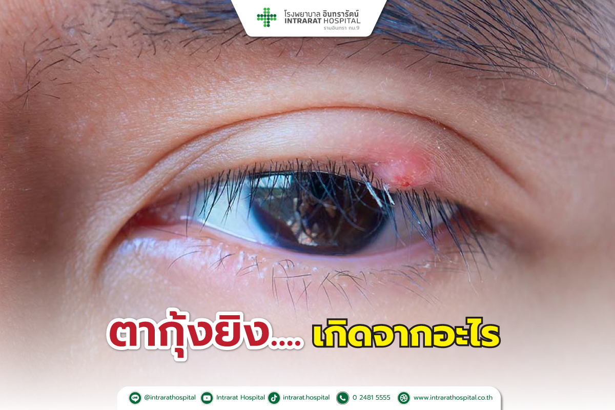 โรคตากุ้งยิง (Hordeolum/Stye)